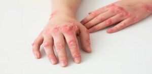 Read more about the article Best Homoeopathic Treatments for Eczema, Psoriasis, and Acne